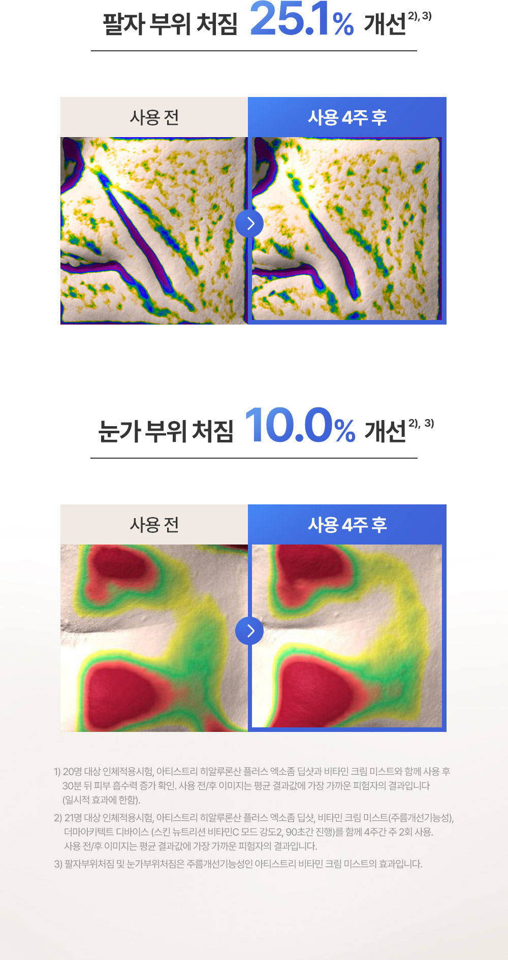 팔자 부위 처짐 25.1% 개선 눈가 부위 처짐 10.0% 개선, 사용 전 사용 4주 후 비교 사진